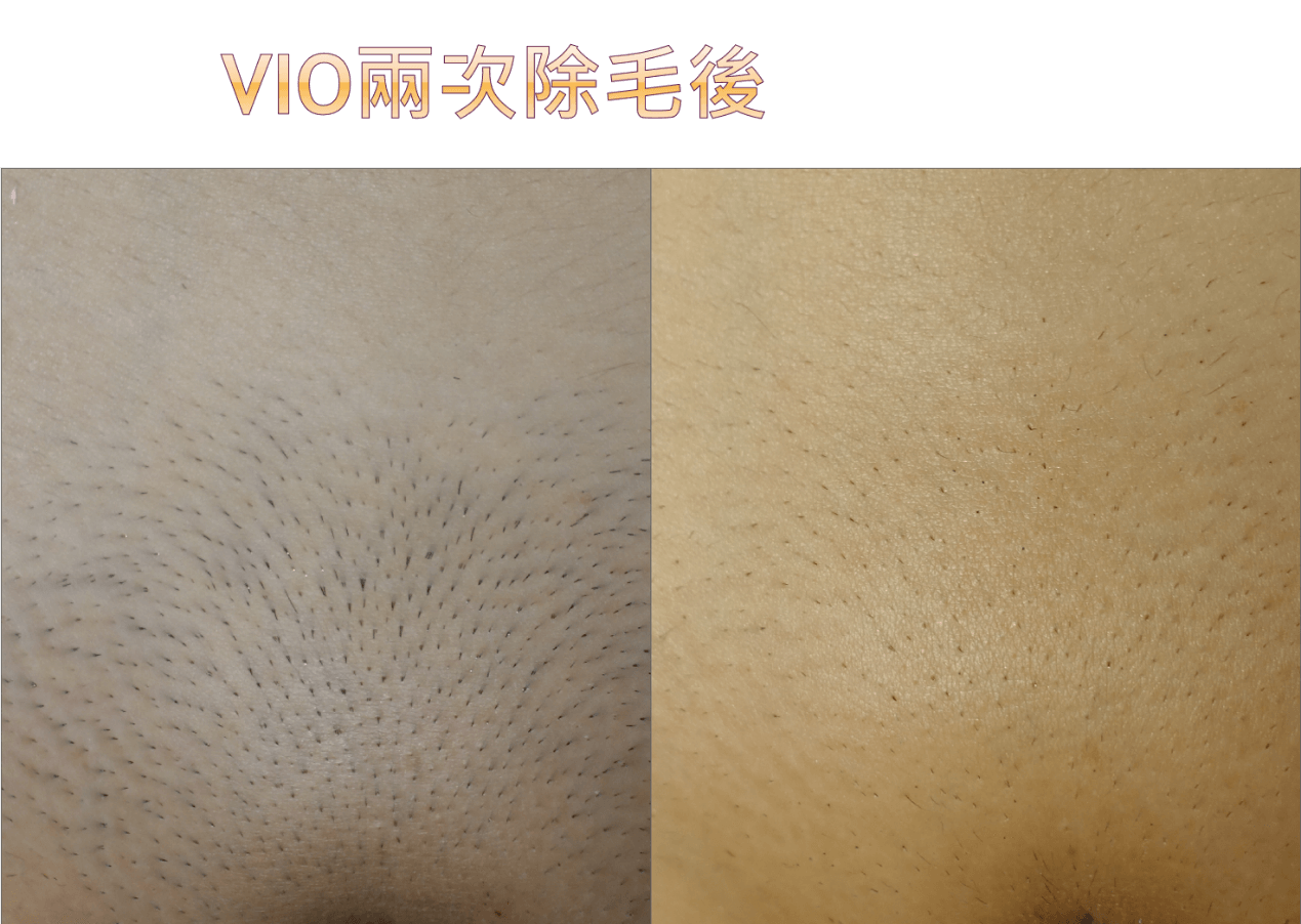 WeE雙波私密處（VIO）除毛